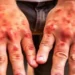 Psoriasis likely to affect men twice