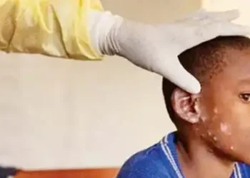 Mpox cases see regular increase