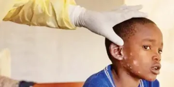 Mpox cases see regular increase