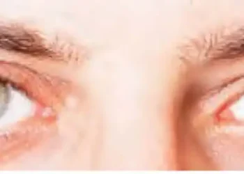 The cure for dry eyes lies in laughter