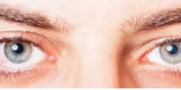 The cure for dry eyes lies in laughter