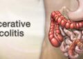 ulcerative