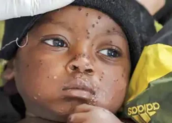 UN nods first mpox vaccine for children