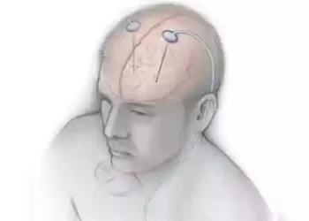 Indian deep brain stimulator market to grow at 10pc CAGR by 2033