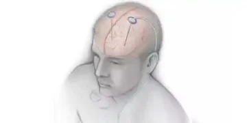 Indian deep brain stimulator market to grow at 10pc CAGR by 2033