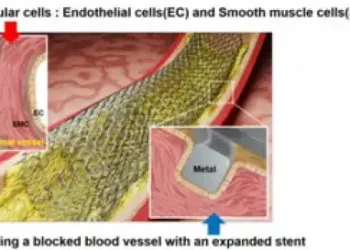 New laser patterning tech to revolutionise stent surgery for heart diseases