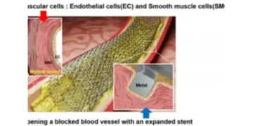New laser patterning tech to revolutionise stent surgery for heart diseases