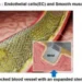 New laser patterning tech to revolutionise stent surgery for heart diseases