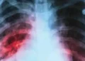 TB cases drop 17.7 pc