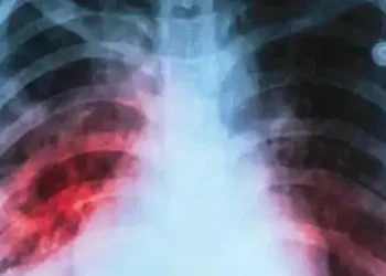 TB cases drop 17.7 pc