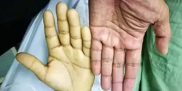 anemia