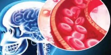 Every year 50 lakh deaths occur due to stroke