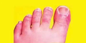 Risk of infection in feet in cold