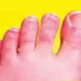 Risk of infection in feet in cold