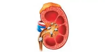 If uric acid increases, it can lead to kidney stones.