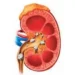 If uric acid increases, it can lead to kidney stones.