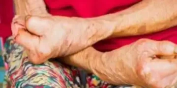 India accounts for 53pc of global leprosy cases, need legal reforms