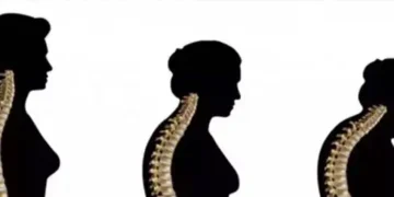 Celltrion's bone disease biosimilars get approval in US