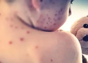 Measles cases mount in Texas