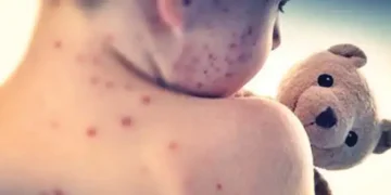 Measles cases mount in Texas