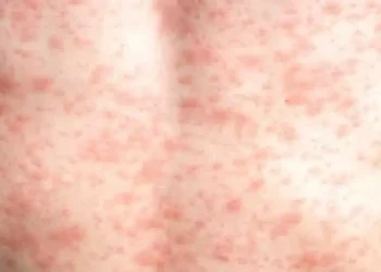 Over 900 measles cases reported in US so far in 2025