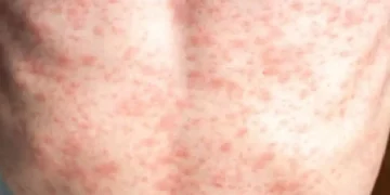 Over 900 measles cases reported in US so far in 2025
