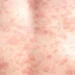 Over 900 measles cases reported in US so far in 2025