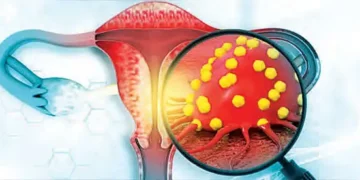 'HPV diagnostic kit' developed for cervical cancer detection