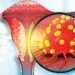 'HPV diagnostic kit' developed for cervical cancer detection