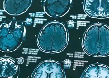 Alzheimer’s drugs too costly for NHS