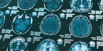 Alzheimer’s drugs too costly for NHS