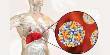 Hepatitis cases are increasing after covid