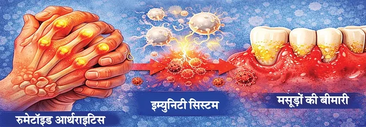 दांतों की बीमारी से हो सकता है गठिया!